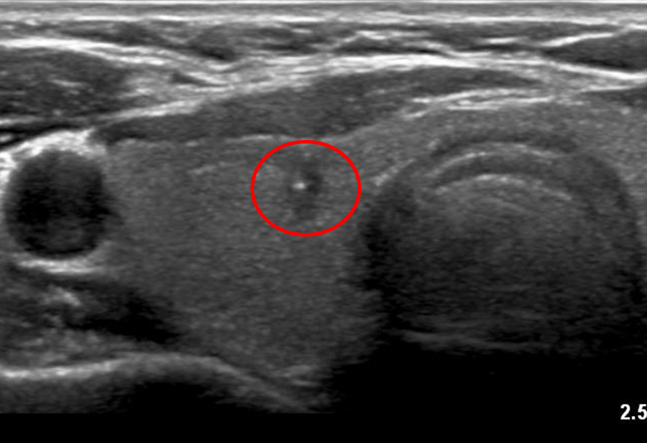 건강검진 초음파 및 세침흡인검사로 확인한 갑상선암 관련 이미지 3