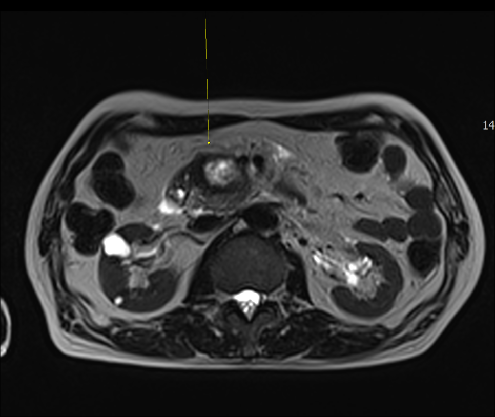 조영 증강 MRI 검사를 통한 췌장암 진단사례 관련 이미지