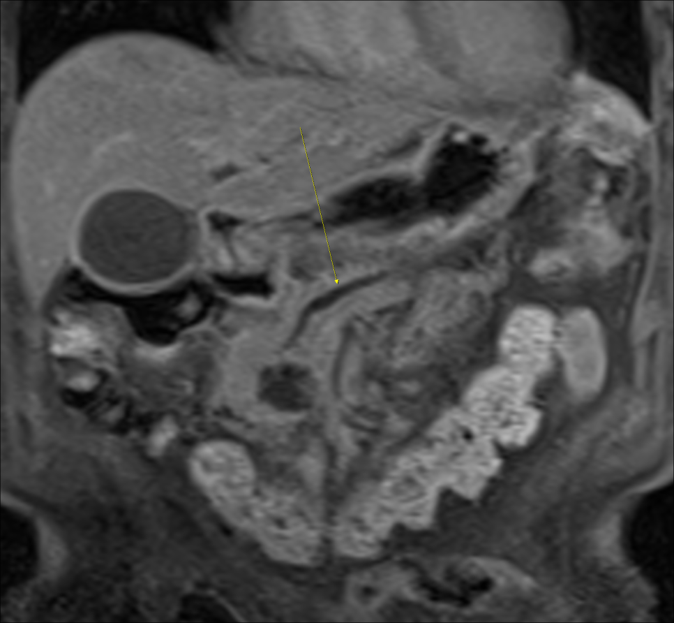 조영 증강 MRI 검사를 통한 췌장암 진단사례 관련 이미지 2