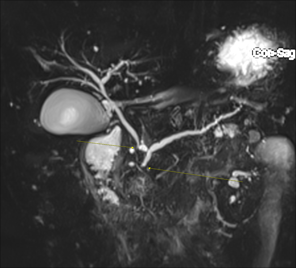 조영 증강 MRI 검사를 통한 췌장암 진단사례 관련 이미지 3
