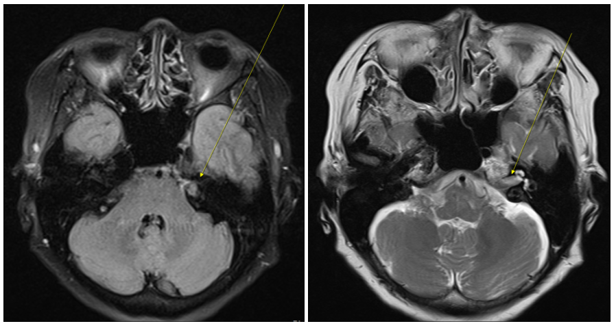 인천 검단구 MRI 검사, 70대 여성 청력 저하 증상과 청신경초종 증례 관련 이미지