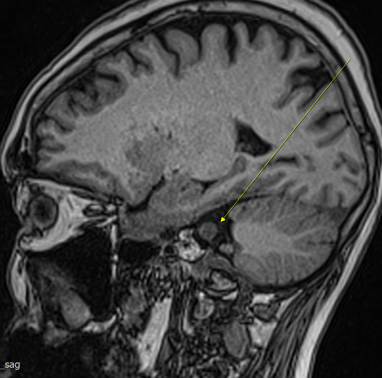 인천 검단구 MRI 검사, 70대 여성 청력 저하 증상과 청신경초종 증례 관련 이미지 2